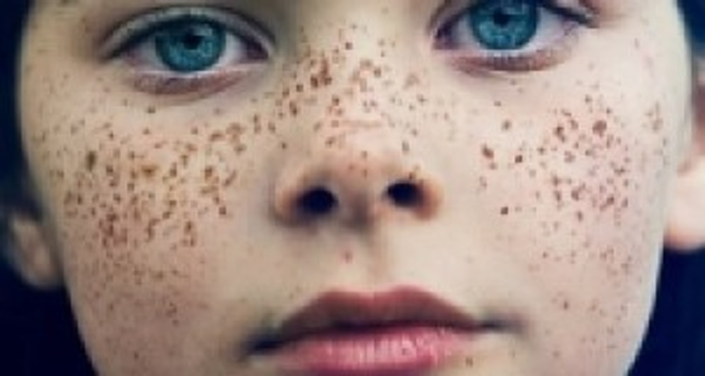 Yüzde Çil Neden Olur, Nasıl Geçer?