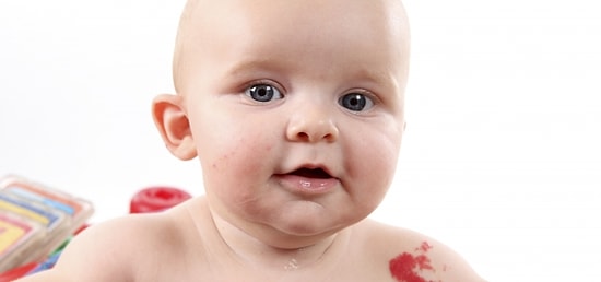 Doğum Lekeleri Endişe Yaratmalı mı?