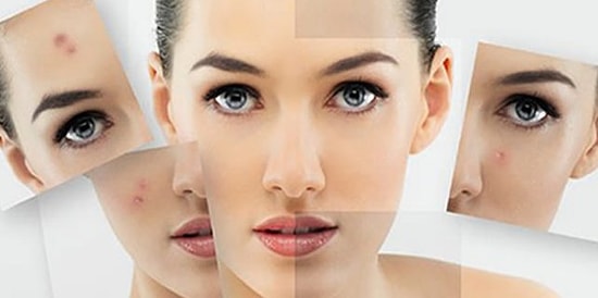 Sivilce Nasıl Geçer?