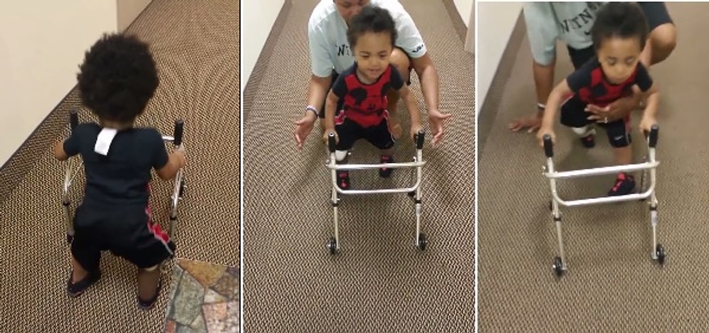 2 Yaşındaki Bebeğin Protez Üzerinde İlk Adımları