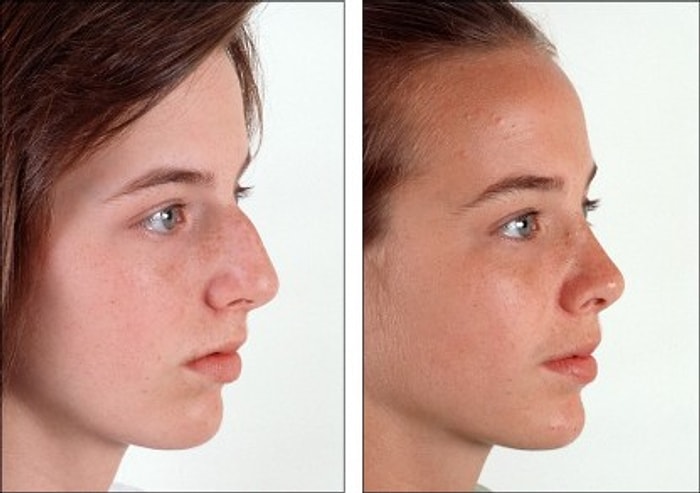 Burun Estetiği Konusunda Bilinmesi Gerekenler