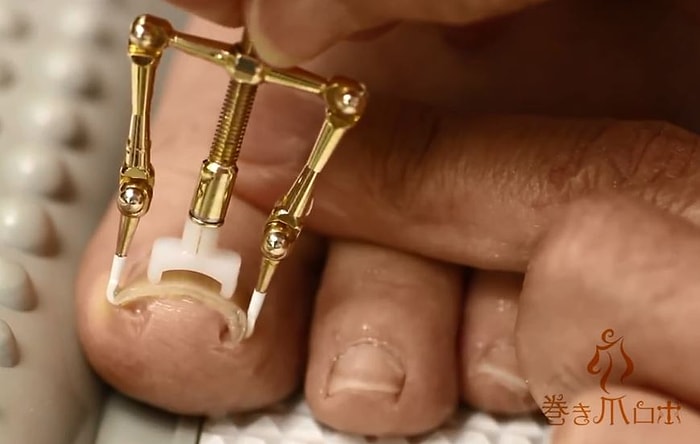 Batık Tırnak Nasıl Düzeltilir?