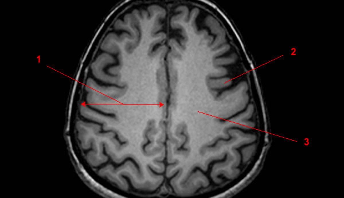 Очаговые изменения мозга дистрофического дисциркуляторного характера. Серое вещество мозга на мрт. Лейкоареоз на кт. Серое и белое вещество мозга на мрт. Перивентрикулярный глиоз.