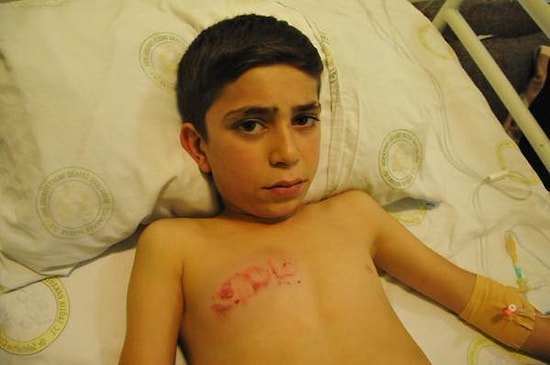 Gaz Fişeğiyle Yaralanan 11 Yaşında Çocuğun Durumu İyiye Gidiyor