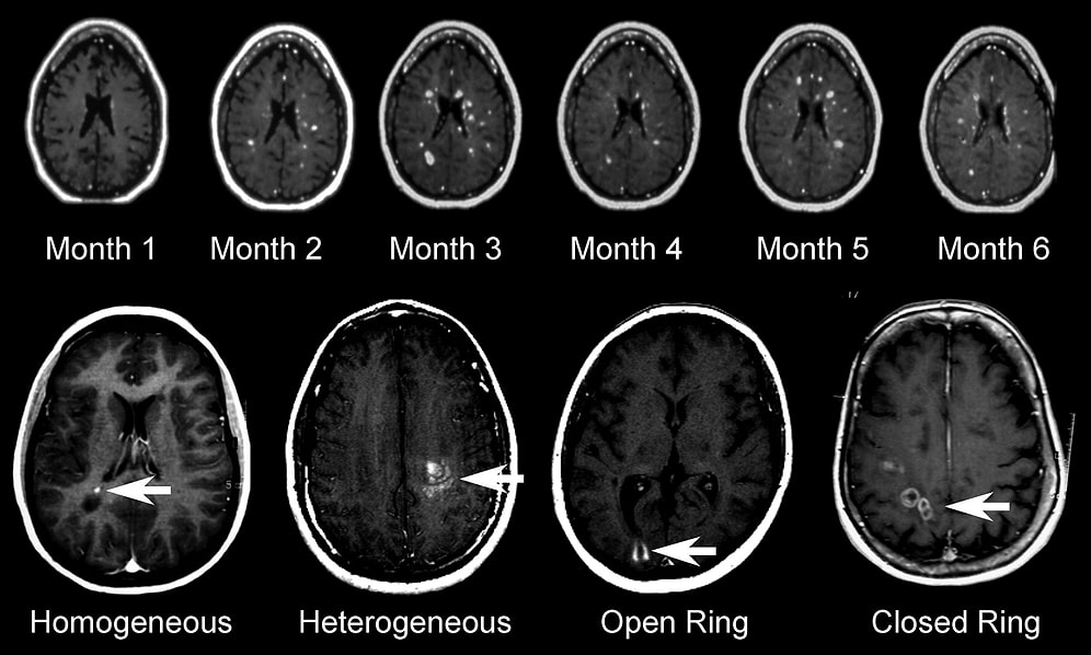 Sebebi Tam Bilinemeyen Hastalık MS (Multiple Skleroz)