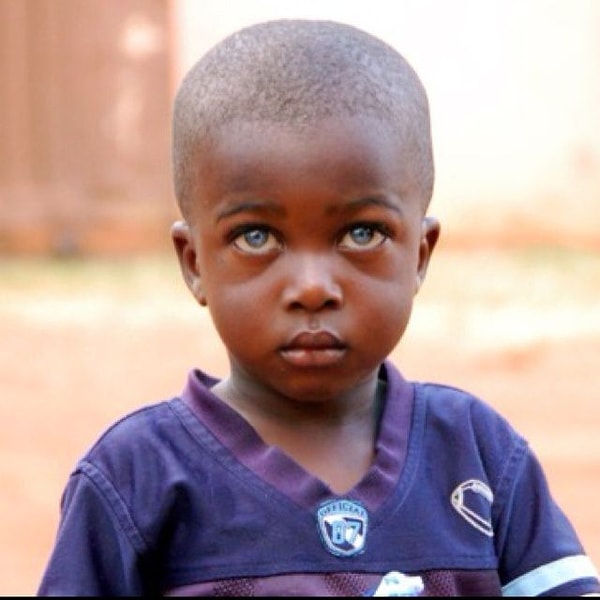 11. Синдром Ваарденбурга, в основном, передается генетически от одного из родителей.