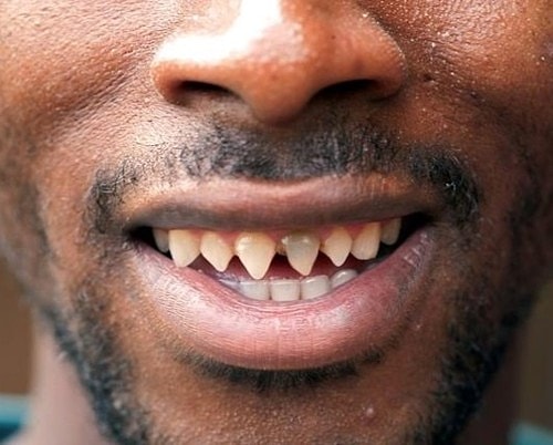 Tooth Sharpening