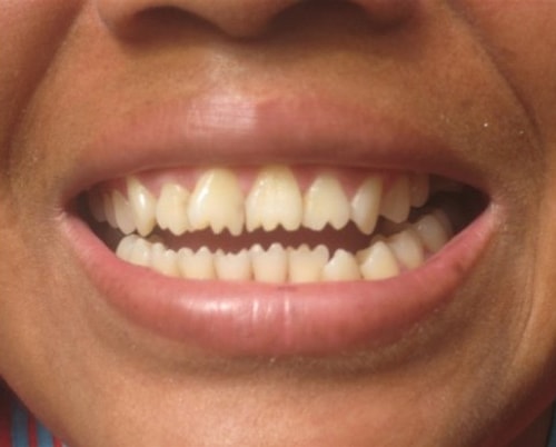 Tooth Sharpening