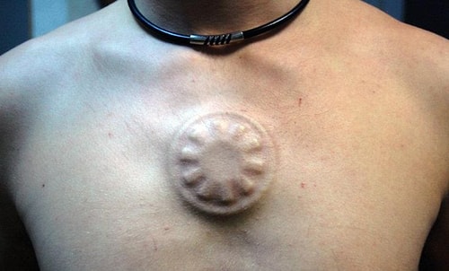 Under Skin Implants