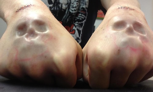 Under Skin Implants