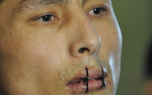 Lip Sewing