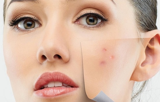 Sivilce Sahibi Herkesin Anlayacağı 24 Gerçek Mücadele