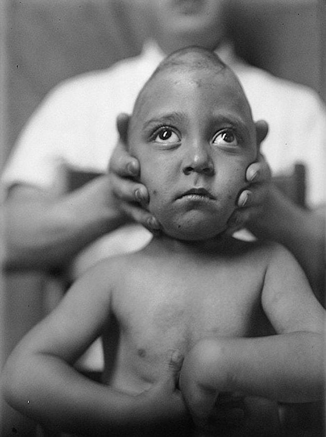 1930'larda Beyin Ameliyatı Olan Hastaların Çektikleri Acıyı Gösteren 19 Fotoğraf