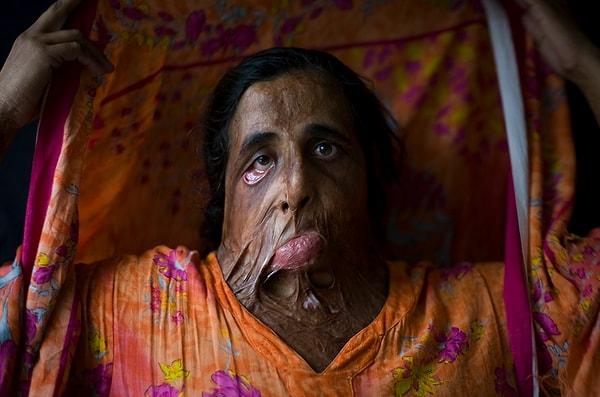 20. Bangladeş'te inanılmaz derecede yaygın bir şiddet örneği var: Kadınların yüzüne asit fırlatmak.
