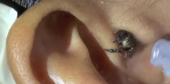 Kulaklarınızı Yıkamayı Unutmayın! Kulağından Örümcek Çıkan Adam