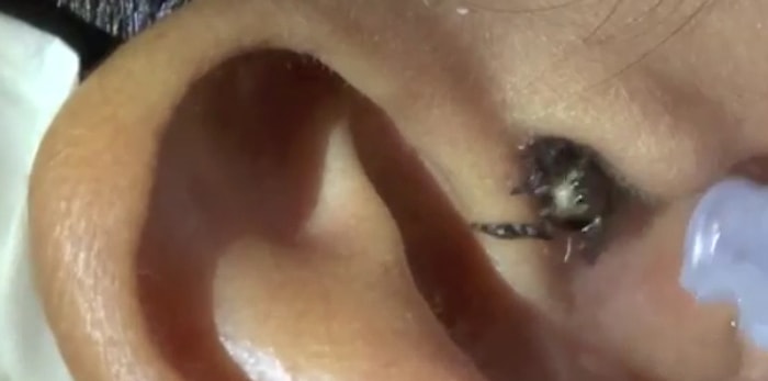 Kulaklarınızı Yıkamayı Unutmayın! Kulağından Örümcek Çıkan Adam