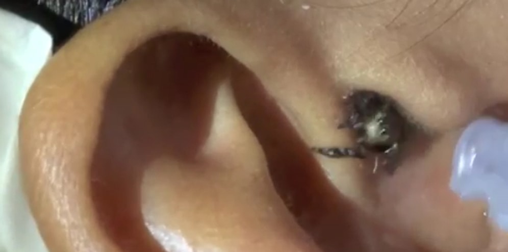 Kulaklarınızı Yıkamayı Unutmayın! Kulağından Örümcek Çıkan Adam