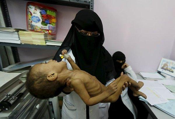 Yemen'de 500 binin üzerinde çocuk hayati tehlikeyle karşı karşıya