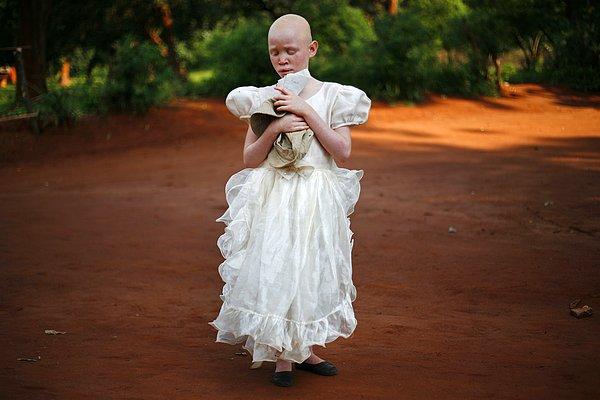 10. Beyaz elbise giyen fiziksel engelli, albino kız çocuğu, Malavi, Afrika