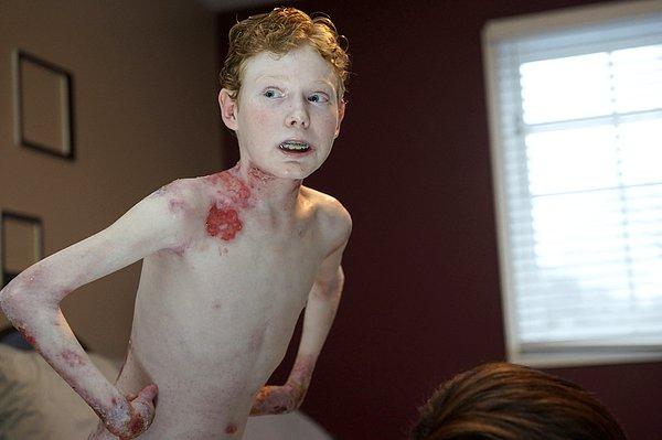 25. Rahatsızlığından dolayı, derisi en ufak sürtünmede bile su toplayan 14 yaşındaki ''Kelebek Çocuk'' Jonathan Pitre.
