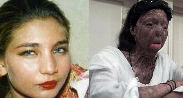 1. Pakistanlı eski dansçı Fakhra Younus, eşinin yüzüne kezzap atmasından 12 yıl sonra intihar etti.