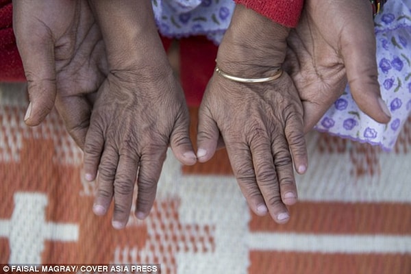 "Мы живем с надеждой на излечение", – говорят родители Кешава и Анджалии.