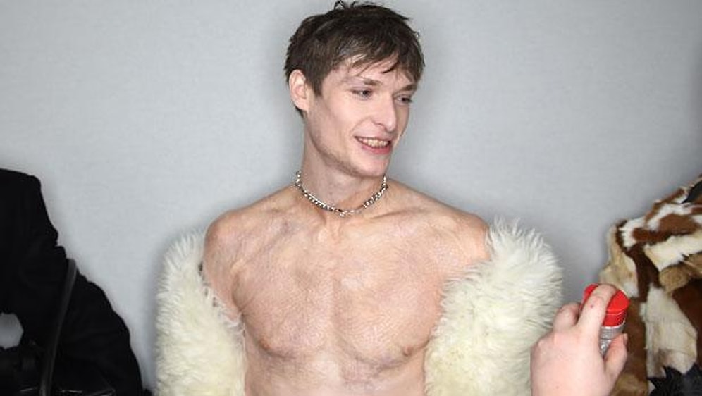 Парень-модель с ожогами по всему телу снова на подиуме!