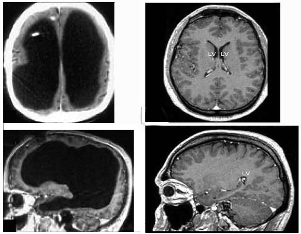 Жидкость в мозгах. Человек без мозга мрт. Мозг без гидроцефалии на снимках мрт. Отсутствие головного мозга мрт. Снимок мрт головы человека без мозга.