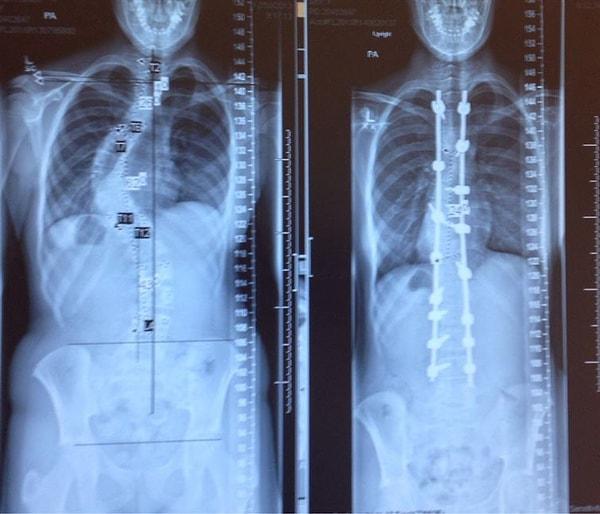 15. Skolyoz hastalığına yakalanan bir kişinin tedaviden önceki ve sonraki röntgen görüntüleri.