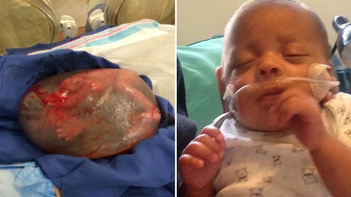 Amniyotik Sıvının İçinde 26 Haftalık Doğan Silas Philips