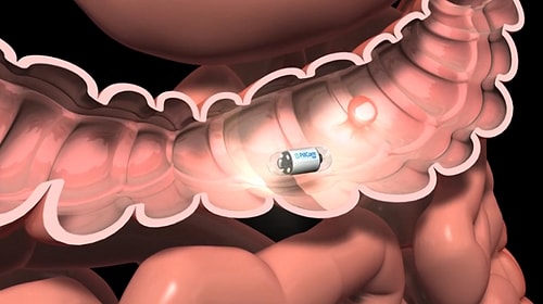 Вы можете проглотить маленькую камеру-капсулу вместо колоноскопии