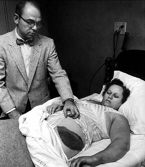 5. Moody Jacobs, tarihte meteor çarpan tek insan olan hastasının büyük yarasını kameralara gösteriyor. (1954)