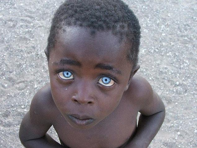 15. Innocence: First of all, the photo hasn't been edited. Blue eyes and dark skin are signs of ocular albinism. This causes eye pigments to be less intense.