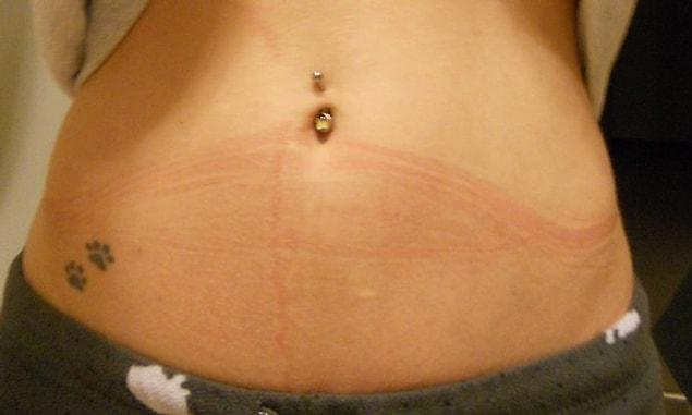 9. When your tights leave weird imprints all over your stomach.
