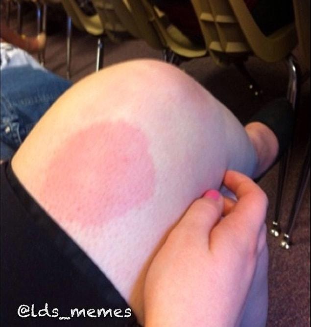 12. This red spot after crossing your legs: