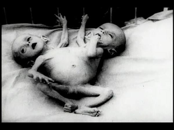 17. Ve belki de müzenin en ilgi çekici parçalarından birisi, yapışık ikizler olarak doğmuş bu bebekler.