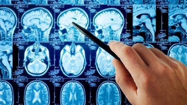 18. Depresyonun Kalıcı Beyin Hasarı Yarattığına Dair Yeni Ulaşılan Bilimsel Kanıtlar ve Çözüm Yolları