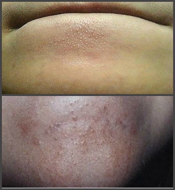 21. Смешав 2 столовые ложки василька и 2 чайные ложки уксуса, можно приготовить маску, которая помогает избавиться от угрей на подбородке. Необходимо помассировать подбородок смесью в течение 10 секунд, а затем смыть.