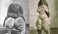 Elephantiasis : Massive Body Swelling!