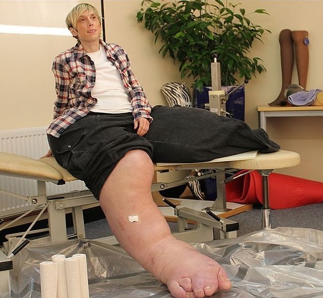 20. Elephantiasis