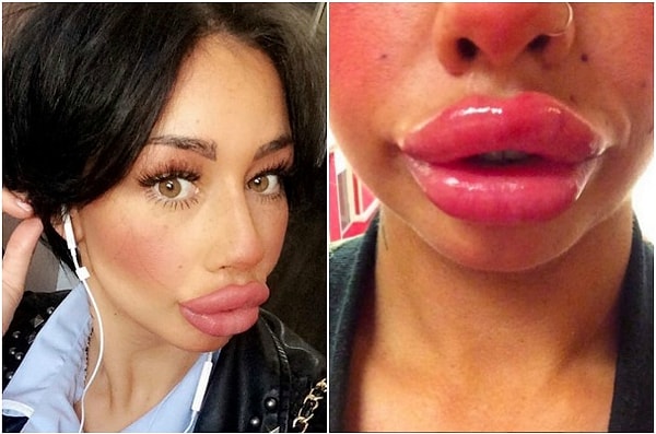 6. "Когда я впервые отправилась в клинику, я оставила там все деньги, которые мама с сестрой подарили мне на день рождения. Постепенно я стала зависимой от таких операций! Ходила туда всякий раз, когда мне казалось, что мои губы недостаточно большие. Каждые несколько месяцев я добавляла по 1 мл".