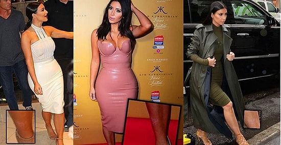 Ким Кардашьян больше не в силах скрывать свой псориаз