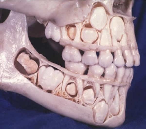 11. Hiç, genç bir insanın kafatasının nasıl göründüğünü merak etmiş miydiniz? İşte henüz bebek dişleriyle yaşarken hayatını kaybetmiş bir insan...