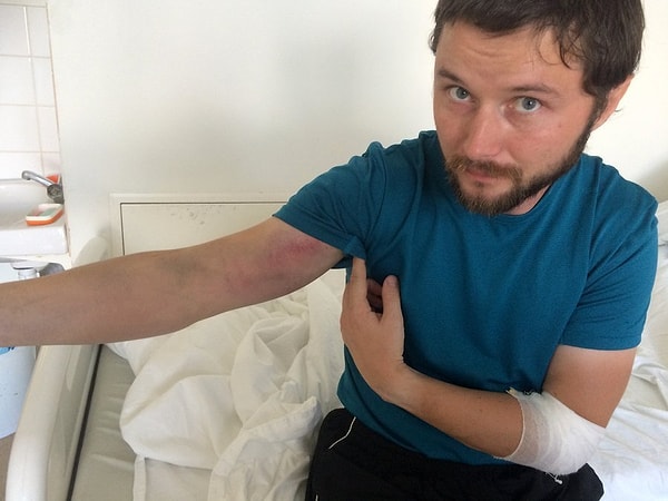 "К концу вторых суток отек спал полностью, остался синяк на всю правую руку. Сжимать что-то правой рукой почти невозможно"