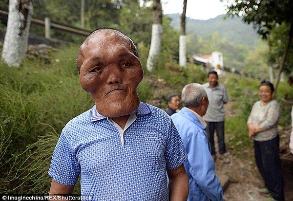 Yuanhai, görünüşünden ötürü yaşadığı köydeki herkes tarafından çok iyi biliniyor. Durdurulamayan doku büyümesi, Yuanhai'nin dişlerinin ezilmesine ve sağır olmasına sebep oldu.