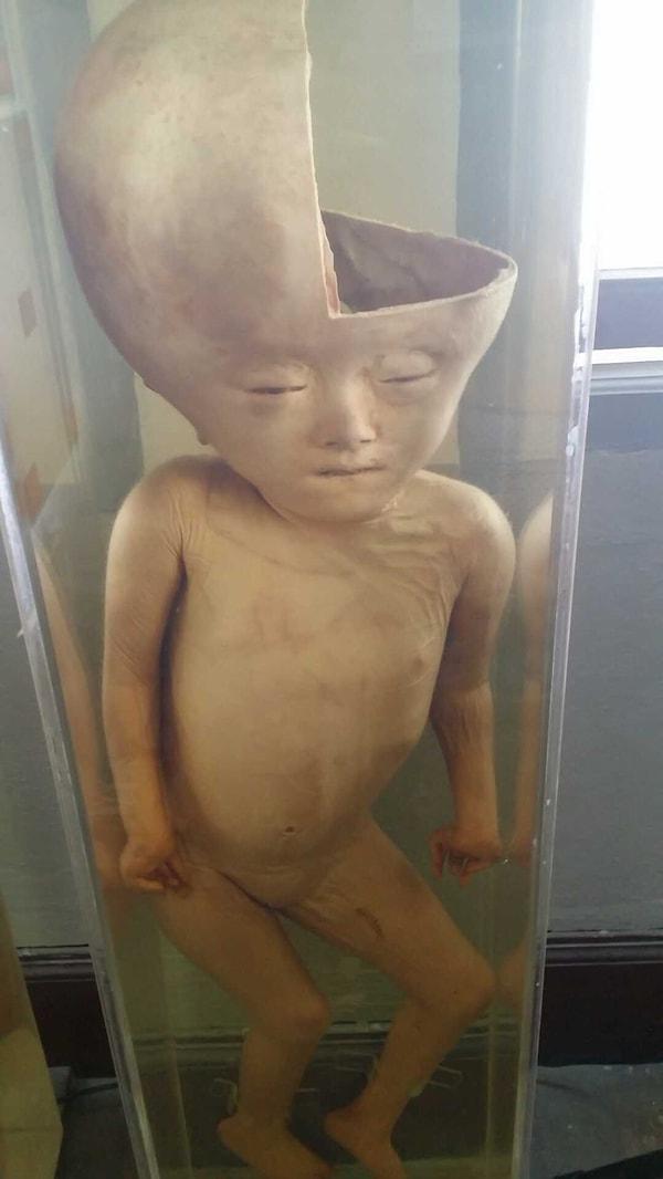 1. Hidrosefaliden ölmüş bir bebek cesedi