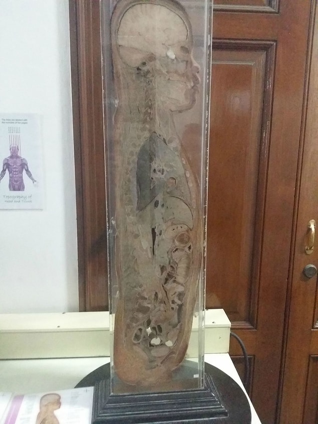 2. A young child's sectioned body