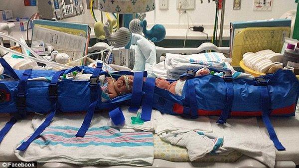 Şimdilik sağlık durumları iyi görünen ikizler 72 saatlik yoğun bakım ardından, aylarca sürecek bir rehabilitasyon süreci bekliyor.