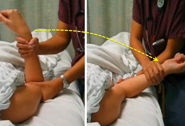 WebMD'ye göre bu manevra doktorun, çocuğun bileğini ve dirseğini tutup, kolu belli bir açıyla dirsek yerine oturana kadar döndürmesiyle gerçekleşiyor.