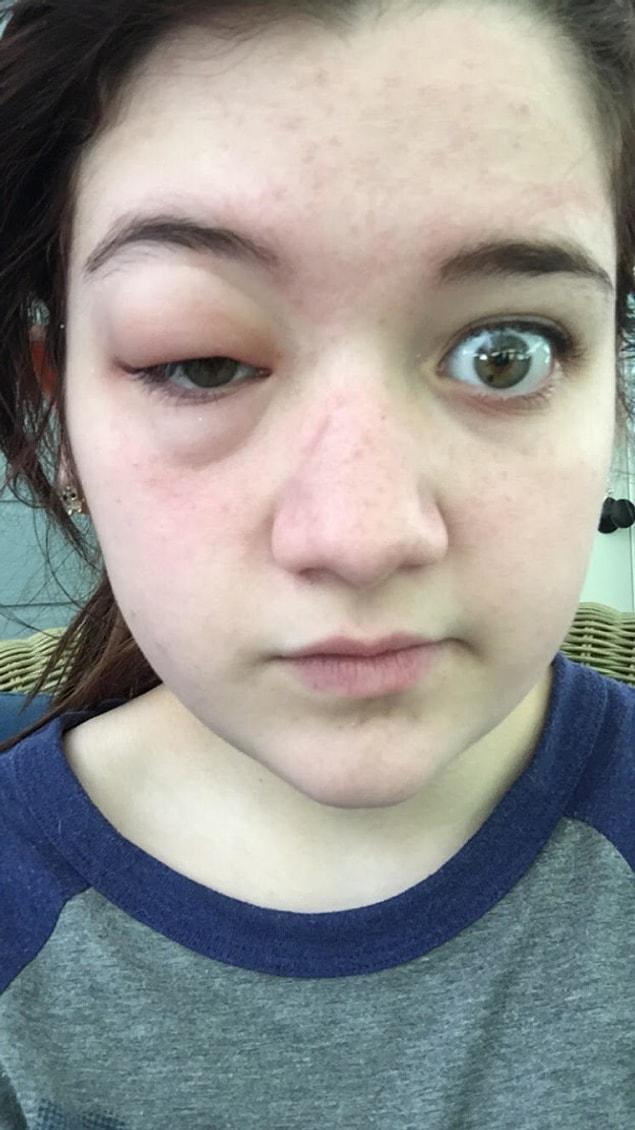 21. This must be the worst allergy ever, she's allergic to mosquitos.